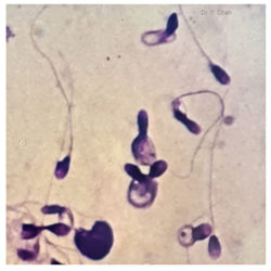 Sperm morphology | LLU Center for Fertility & IVF | Coiled tail sperm