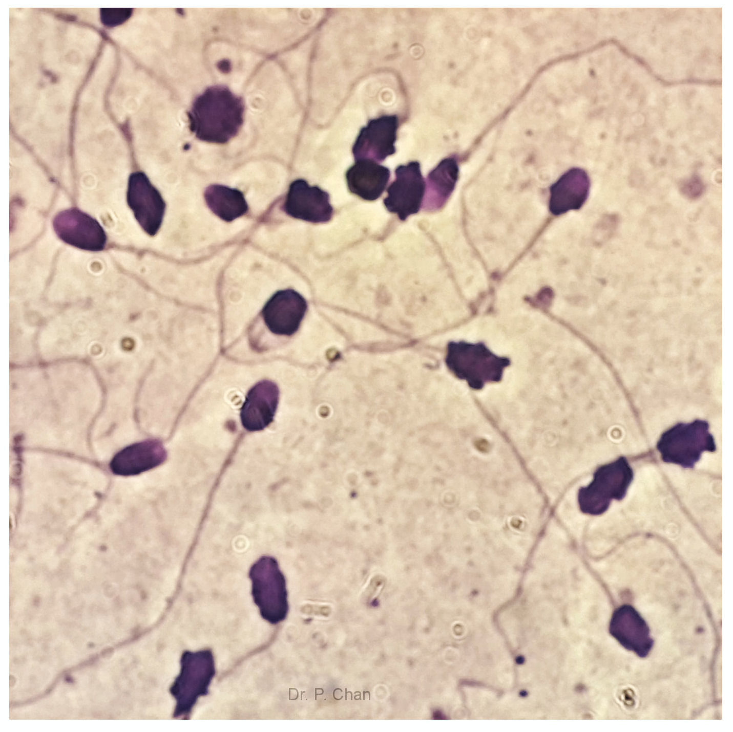photoDecondensingHeadsperm Loma Linda University Center for Fertility & IVF