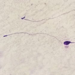 Sperm morphology | LLU Center for Fertility & IVF | Headless sperm