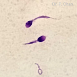 Sperm morphology | LLU Center for Fertility | stump tail sperm