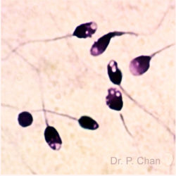 Sperm morphology | LLU Center for Fertility IVF | Nuclear vacuoles sperm